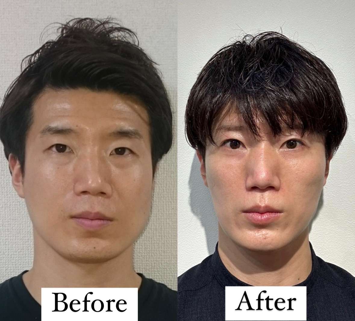 鼻 大きい コンプレックス
