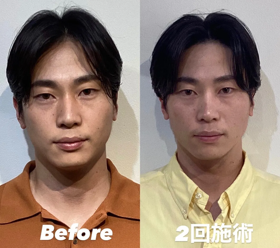 男性の咬筋緩和で輪郭と姿勢改善