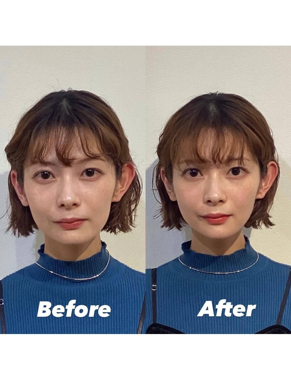 咬筋と胸鎖乳突筋の左右差が招く顎ズレ