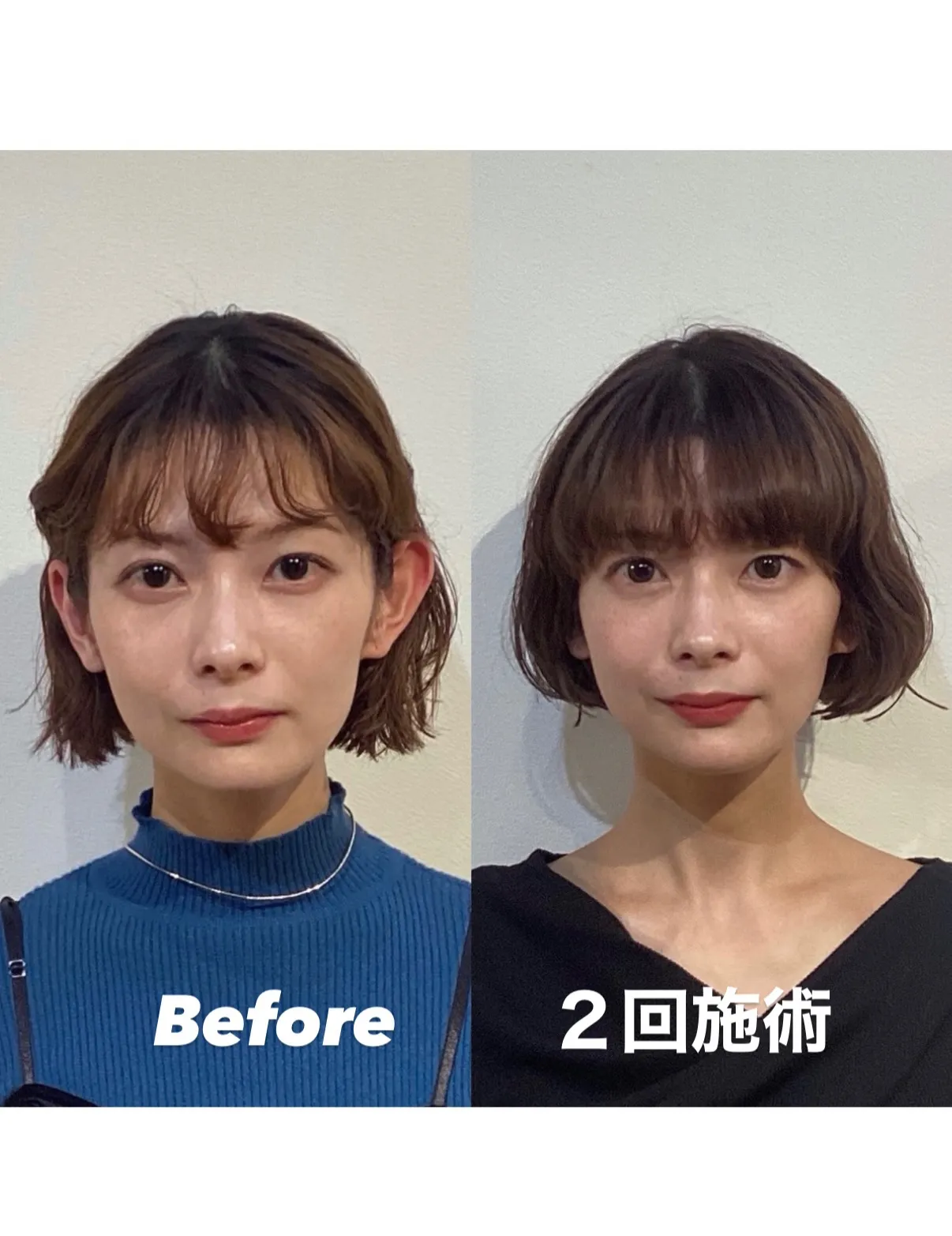 咬筋と胸鎖乳突筋の左右差が招く顎ズレ