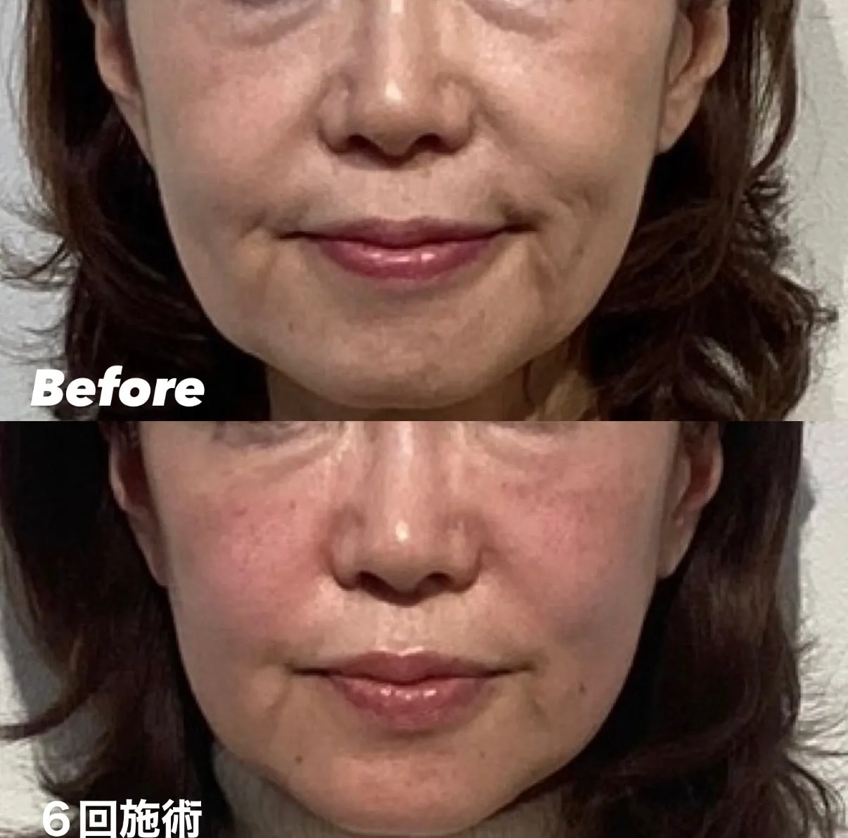 マリオネットラインの原因と緊張緩和法